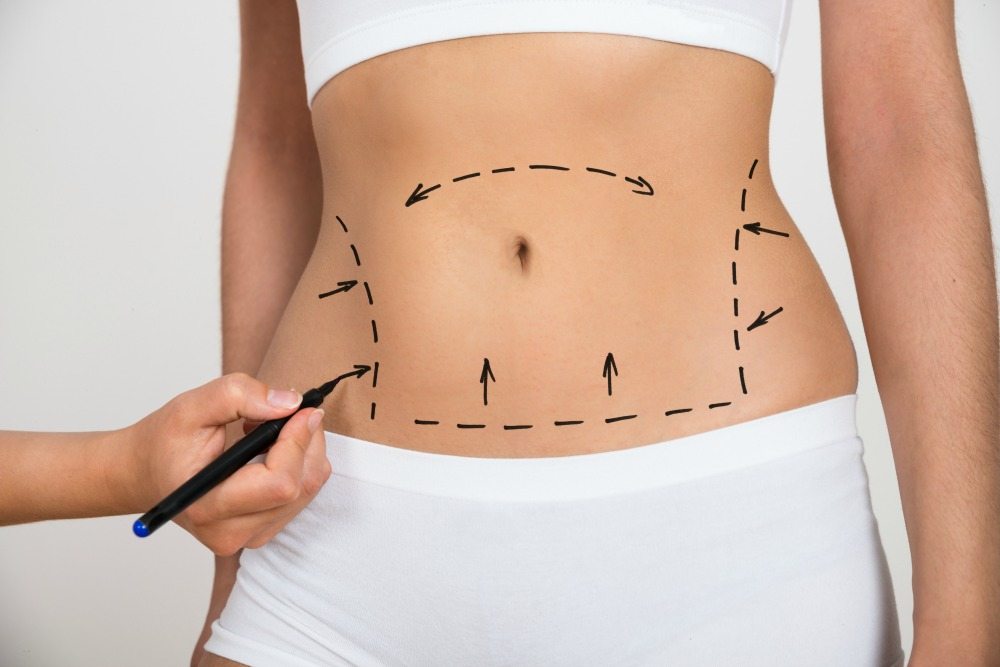 Tummy Tuck Surgery In Newcastle upon Tyne